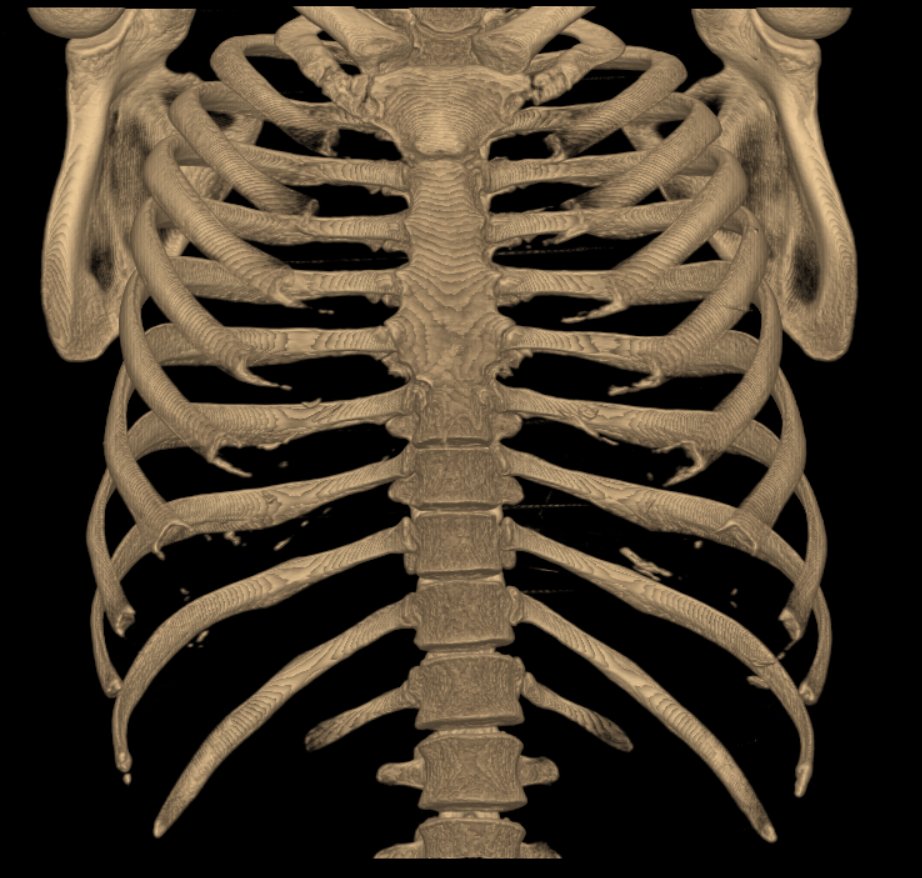 3D Volume Rendering в MedVisor